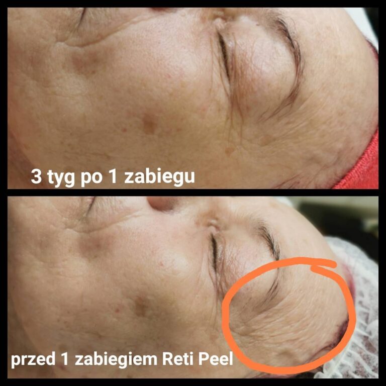 Reti Peel centrum urody faustyna micał 5
