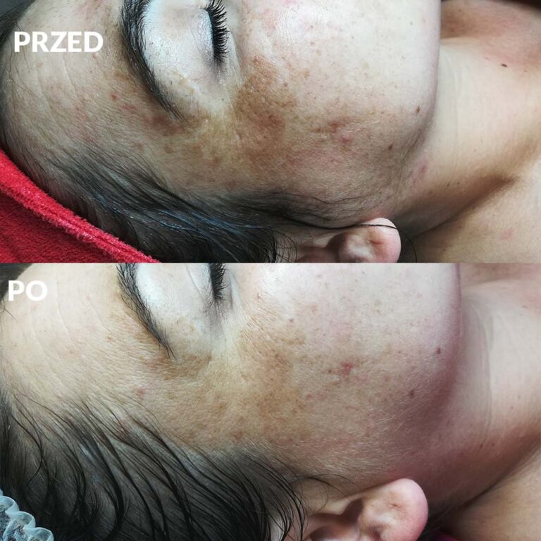 Reti Peel centrum urody faustyna micał 6