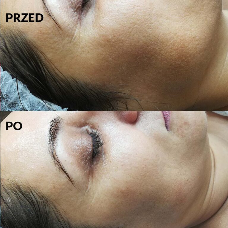 Reti Peel centrum urody faustyna micał 7