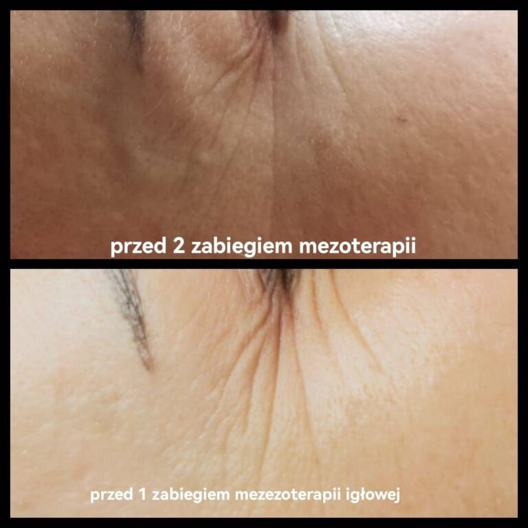 mezoterapia centrum urody faustyna micał 1