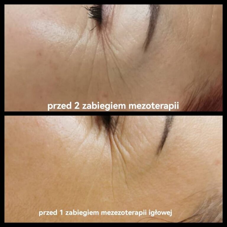 mezoterapia centrum urody faustyna micał 2